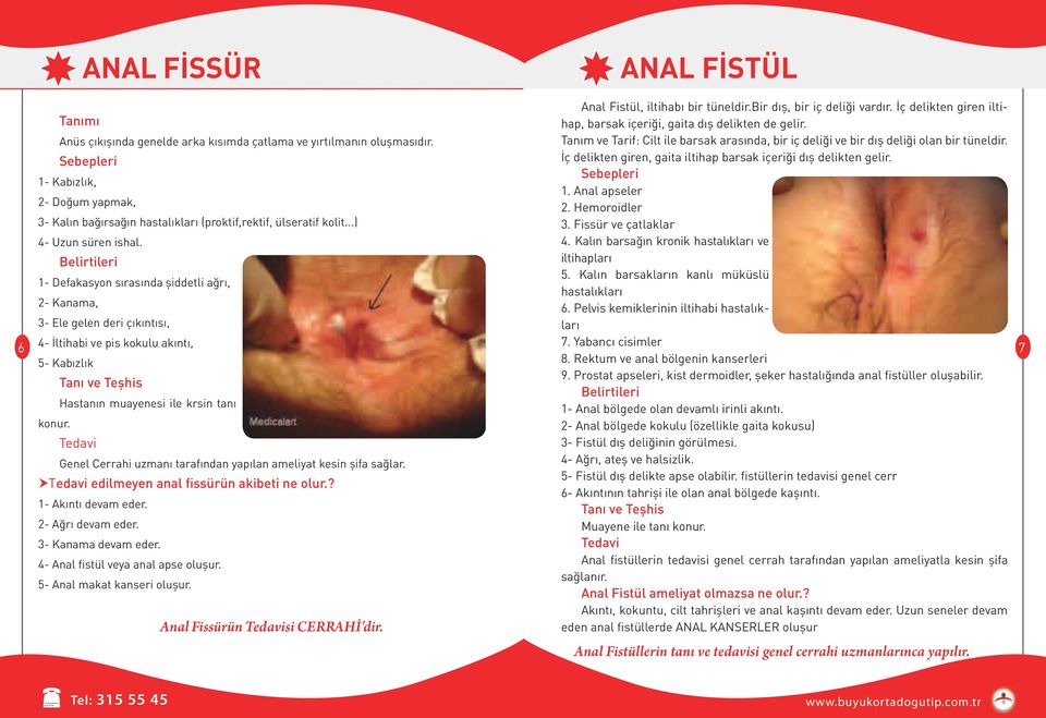 Sebepleri İç delikten giren, gaita iltihap barsak içeriği dış delikten gelir. Sebepleri 1- Kabızlık, 1. Anal apseler 2- Doğum yapmak, 2.