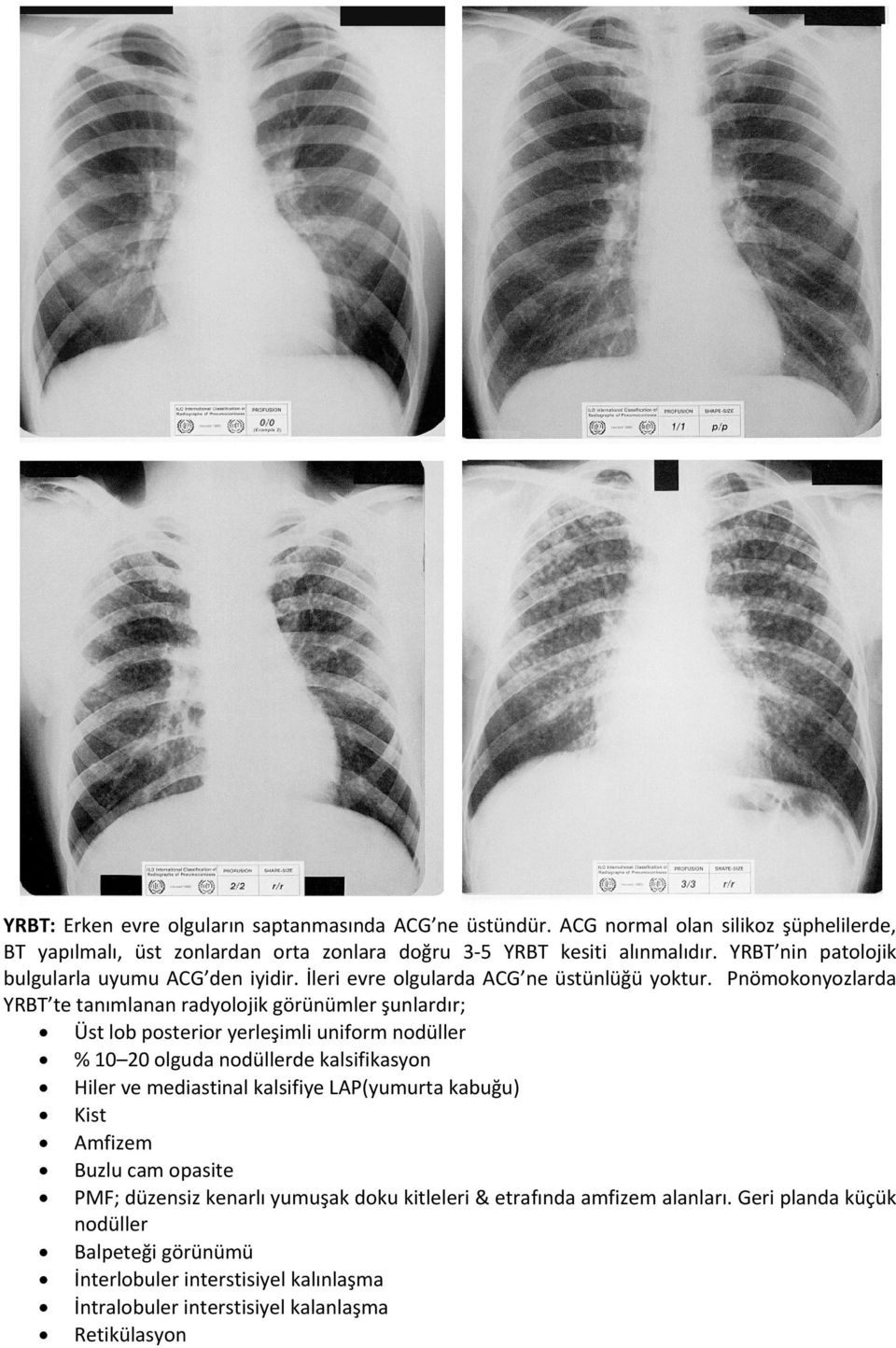 Pnömokonyozlarda YRBT te tanımlanan radyolojik görünümler şunlardır; Üst lob posterior yerleşimli uniform nodüller % 10 20 olguda nodüllerde kalsifikasyon Hiler ve mediastinal