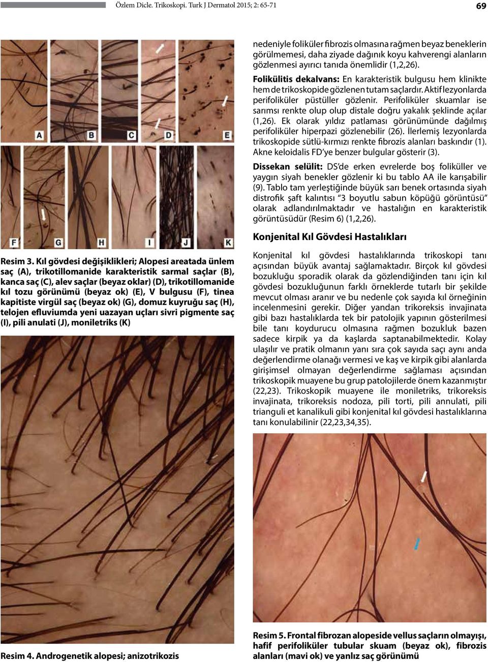 Folikülitis dekalvans: En karakteristik bulgusu hem klinikte hem de trikoskopide gözlenen tutam saçlardır. Aktif lezyonlarda perifoliküler püstüller gözlenir.