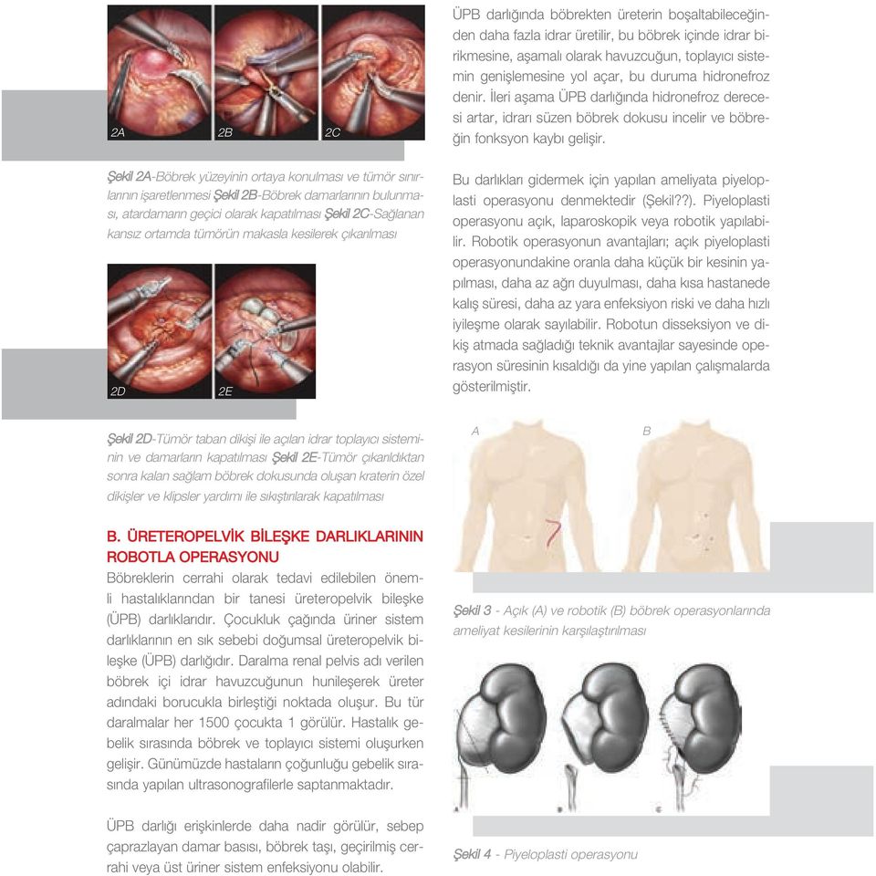fiekil 2A-Böbrek yüzeyinin ortaya konulmas ve tümör s n rlar n n iflaretlenmesi fiekil 2B-Böbrek damarlar n n bulunmas, atardamar n geçici olarak kapat lmas fiekil 2C-Sa lanan kans z ortamda tümörün