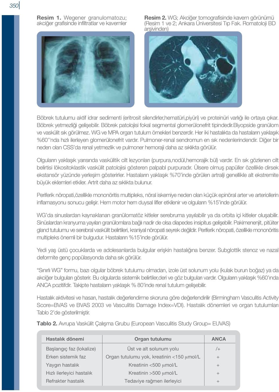 Böbrek patolojisi fokal segmental glomerülonefrit tipindedir.biyopside granülom ve vaskülit sık görülmez. WG ve MPA organ tutulum örnekleri benzerdir.