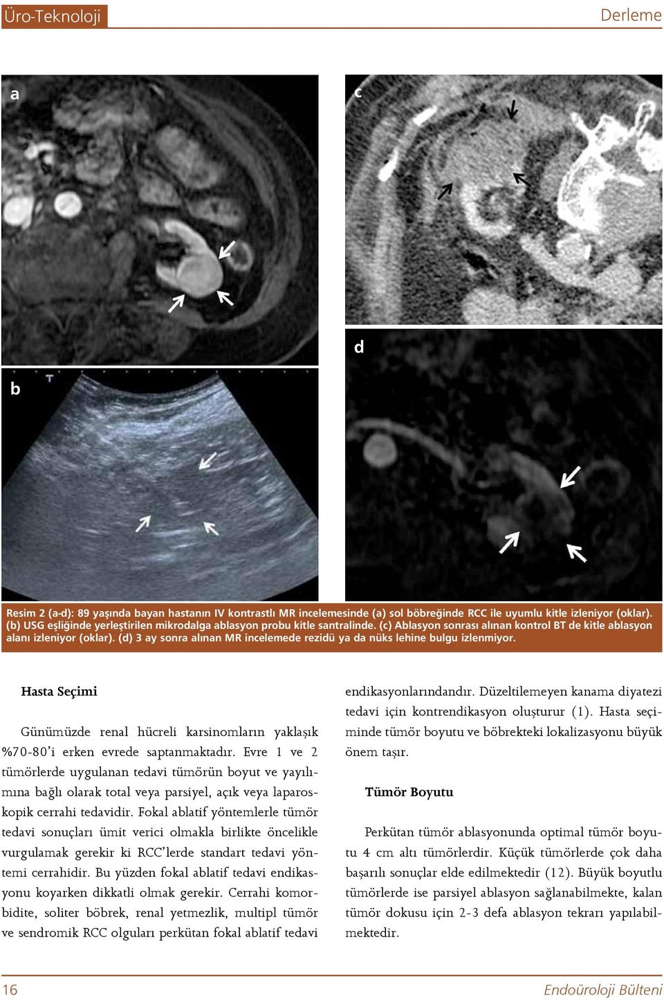 (d) 3 ay sonra alınan MR incelemede rezidü ya da nüks lehine bulgu izlenmiyor. Hasta Seçimi Günümüzde renal hücreli karsinomların yaklaşık %70-80 i erken evrede saptanmaktadır.