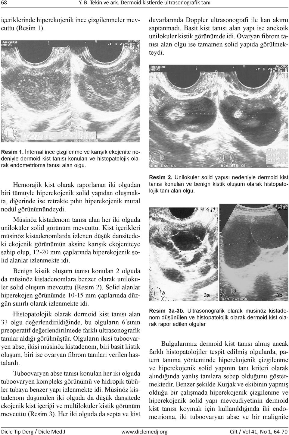 İnternal ince çizgilenme ve karışık ekojenite nedeniyle dermoid kist tanısı konulan ve histopatolojik olarak endometrioma tanısı alan olgu.