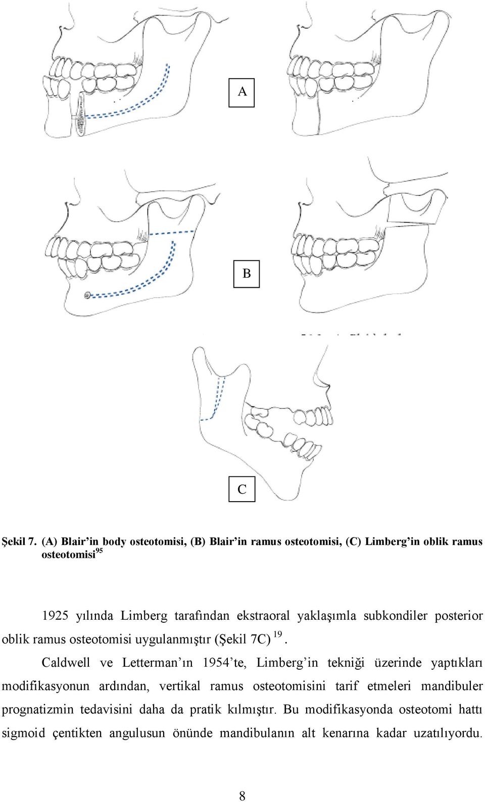 ekstraoral yaklaģımla subkondiler posterior oblik ramus osteotomisi uygulanmıģtır (ġekil 7C) 19.