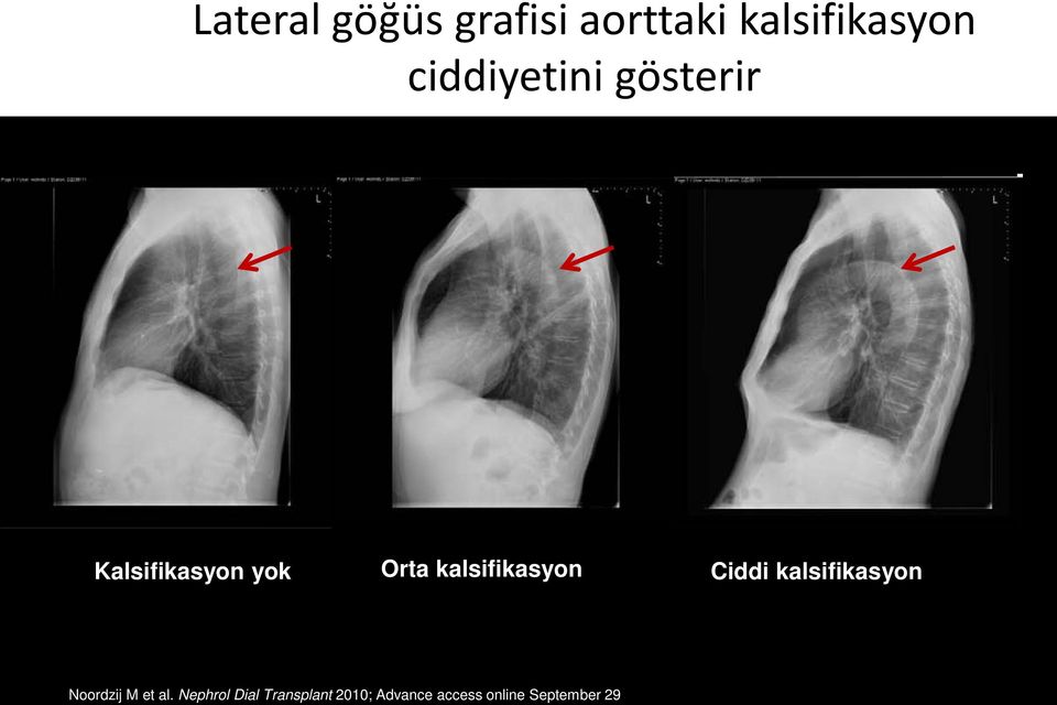 kalsifikasyon Ciddi kalsifikasyon Noordzij M et al.