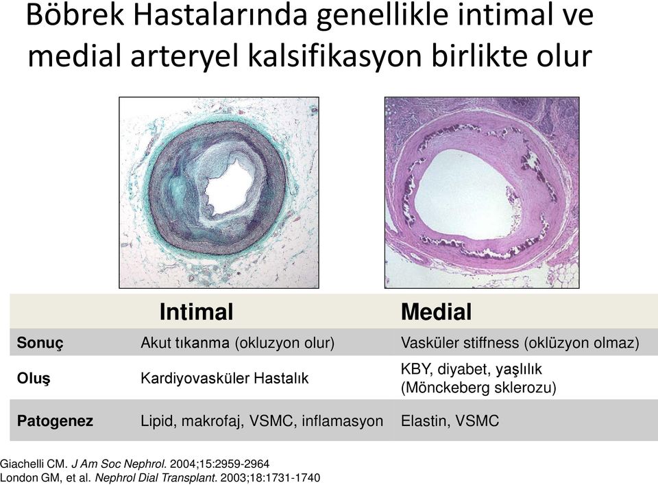 KBY, diyabet, yaşlılık (Mönckeberg sklerozu) Patogenez Lipid, makrofaj, VSMC, inflamasyon Elastin, VSMC