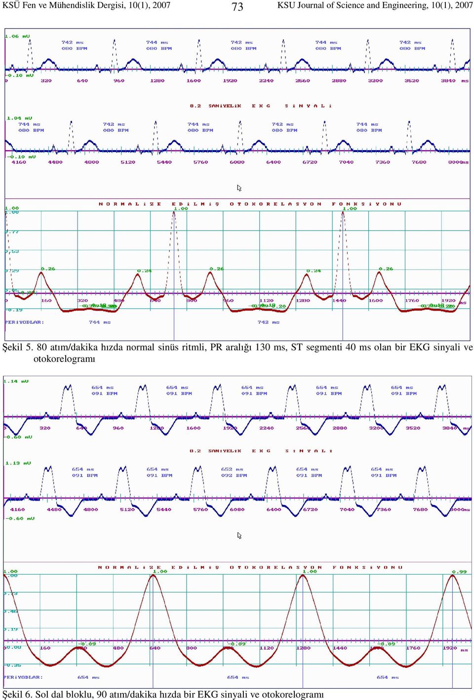 80 atım/dakika hızda normal sinüs ritmli, PR aralığı 130 ms, ST segmenti 40