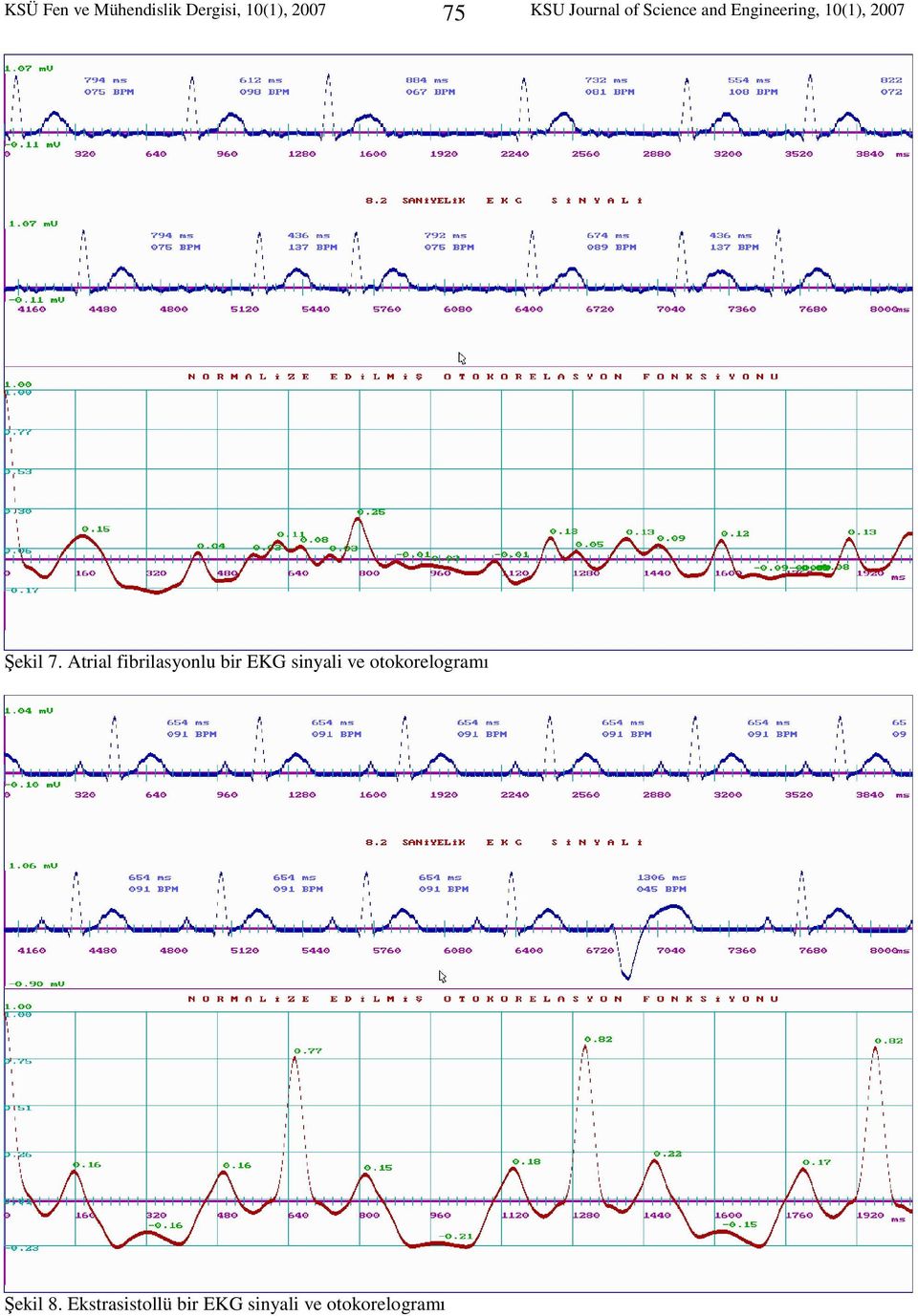 7. Atrial fibrilasyonlu bir EKG sinyali ve