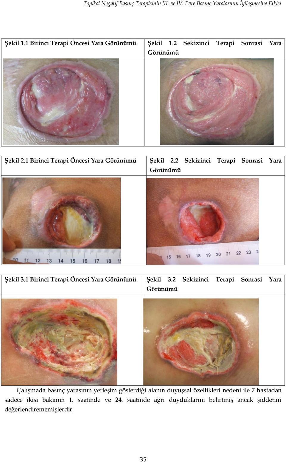 1 Birinci Terapi Öncesi Yara Görünümü Şekil 3.