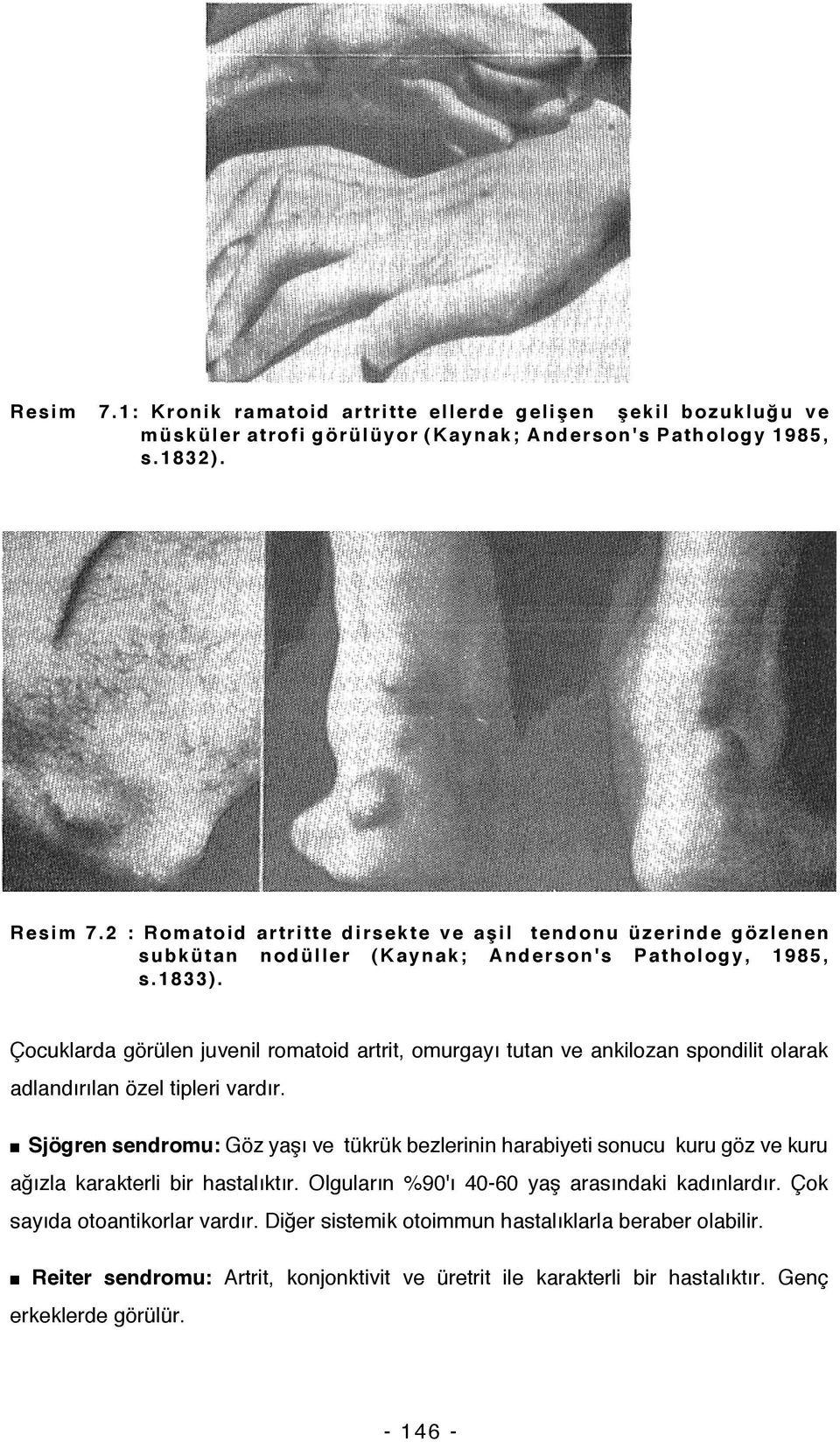 Çocuklarda görülen juvenil romatoid artrit, omurgayı tutan ve ankilozan spondilit olarak adlandırılan özel tipleri vardır.