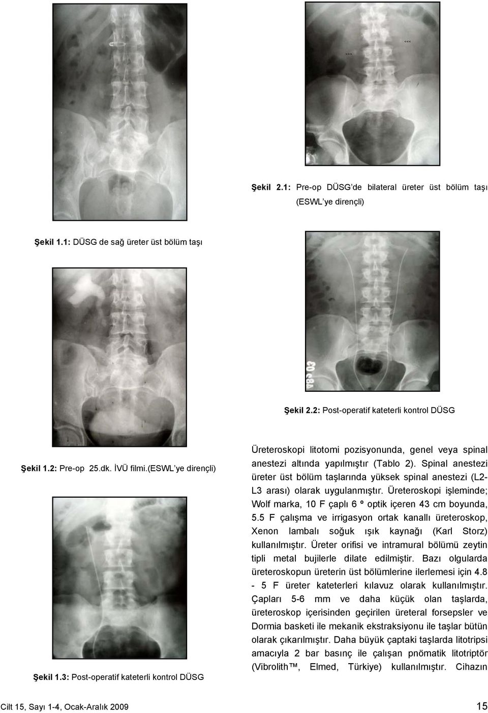 Spinal anestezi üreter üst bölüm taşlarında yüksek spinal anestezi (L2- L3 arası) olarak uygulanmıştır. Üreteroskopi işleminde; Wolf marka, 10 F çaplı 6 º optik içeren 43 cm boyunda, 5.