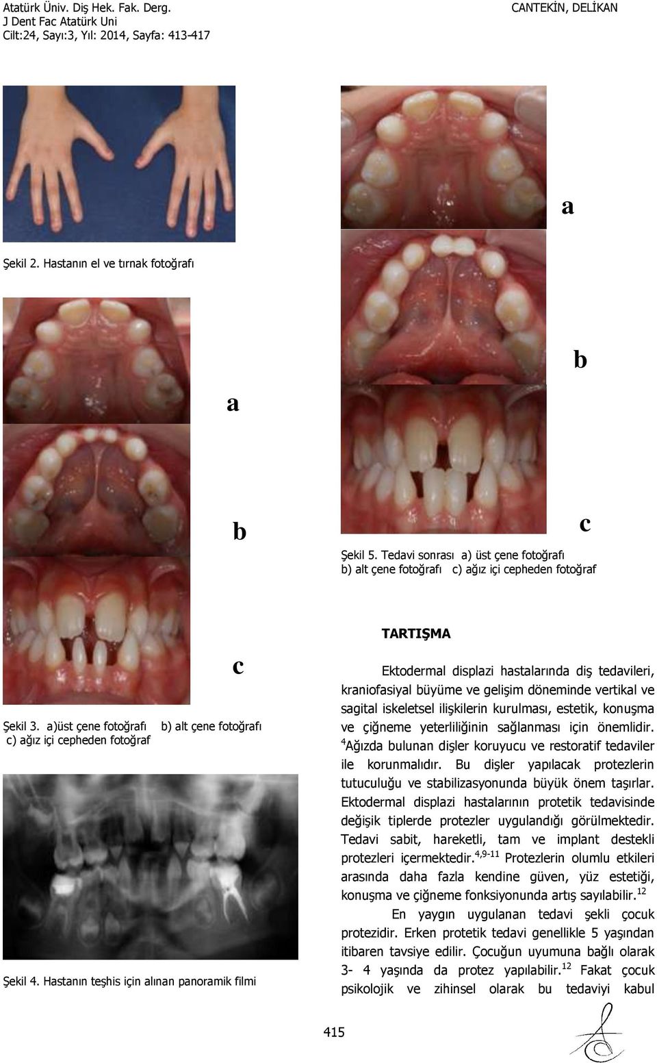 Hastanın teşhis için alınan panoramik filmi c TARTIŞMA Ektodermal displazi hastalarında diş tedavileri, kraniofasiyal büyüme ve gelişim döneminde vertikal ve sagital iskeletsel ilişkilerin kurulması,