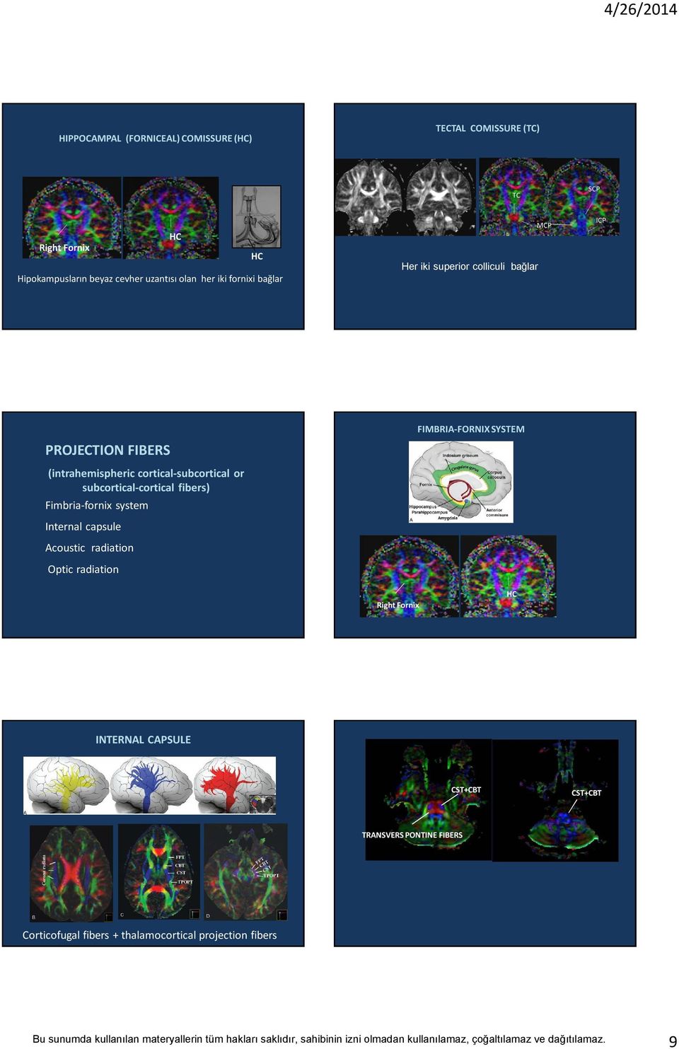 or subcortical-cortical fibers) Fimbria-fornix system Internal capsule coustic radiation Optic radiation FIMBI-FONIX