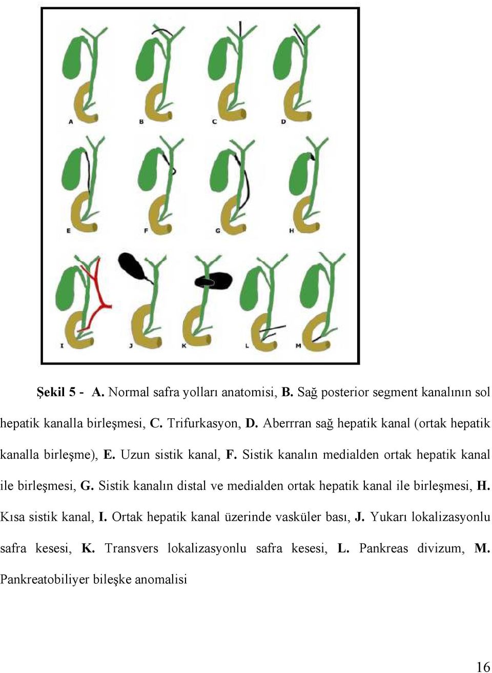 Sistik kanalın medialden ortak hepatik kanal ile birleşmesi, G. Sistik kanalın distal ve medialden ortak hepatik kanal ile birleşmesi, H.