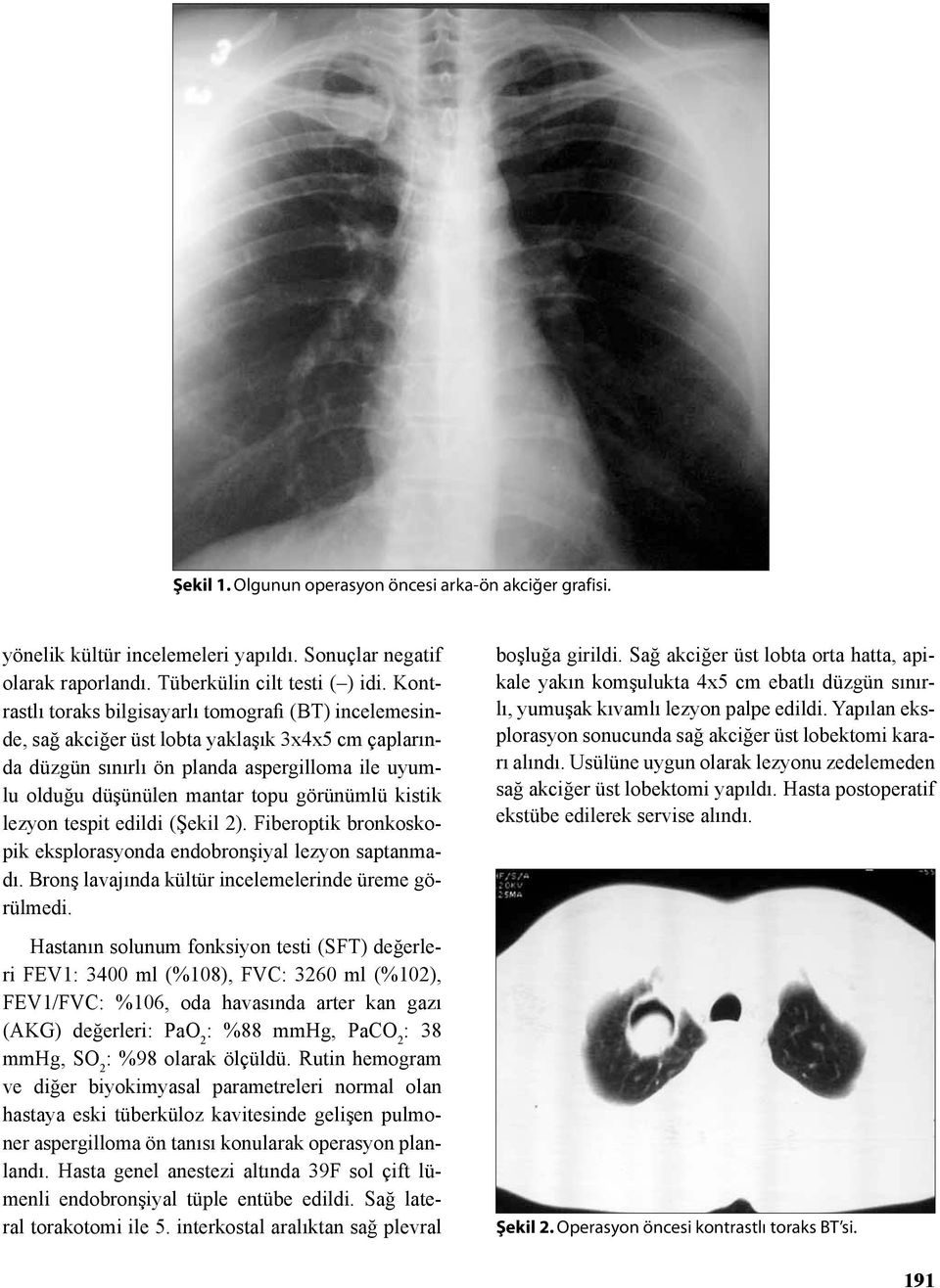 kistik lezyon tespit edildi (Şekil 2). Fiberoptik bronkoskopik eksplorasyonda endobronşiyal lezyon saptanmadı. Bronş lavajında kültür incelemelerinde üreme görülmedi.