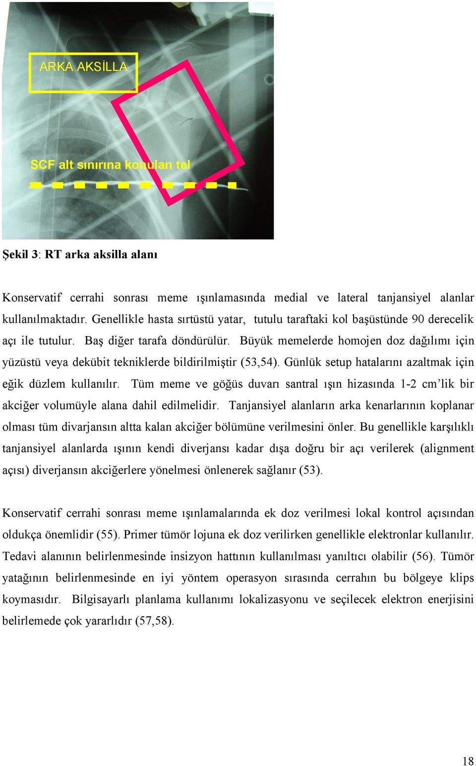 Büyük memelerde homojen doz dağılımı için yüzüstü veya dekübit tekniklerde bildirilmiştir (53,54). Günlük setup hatalarını azaltmak için eğik düzlem kullanılır.