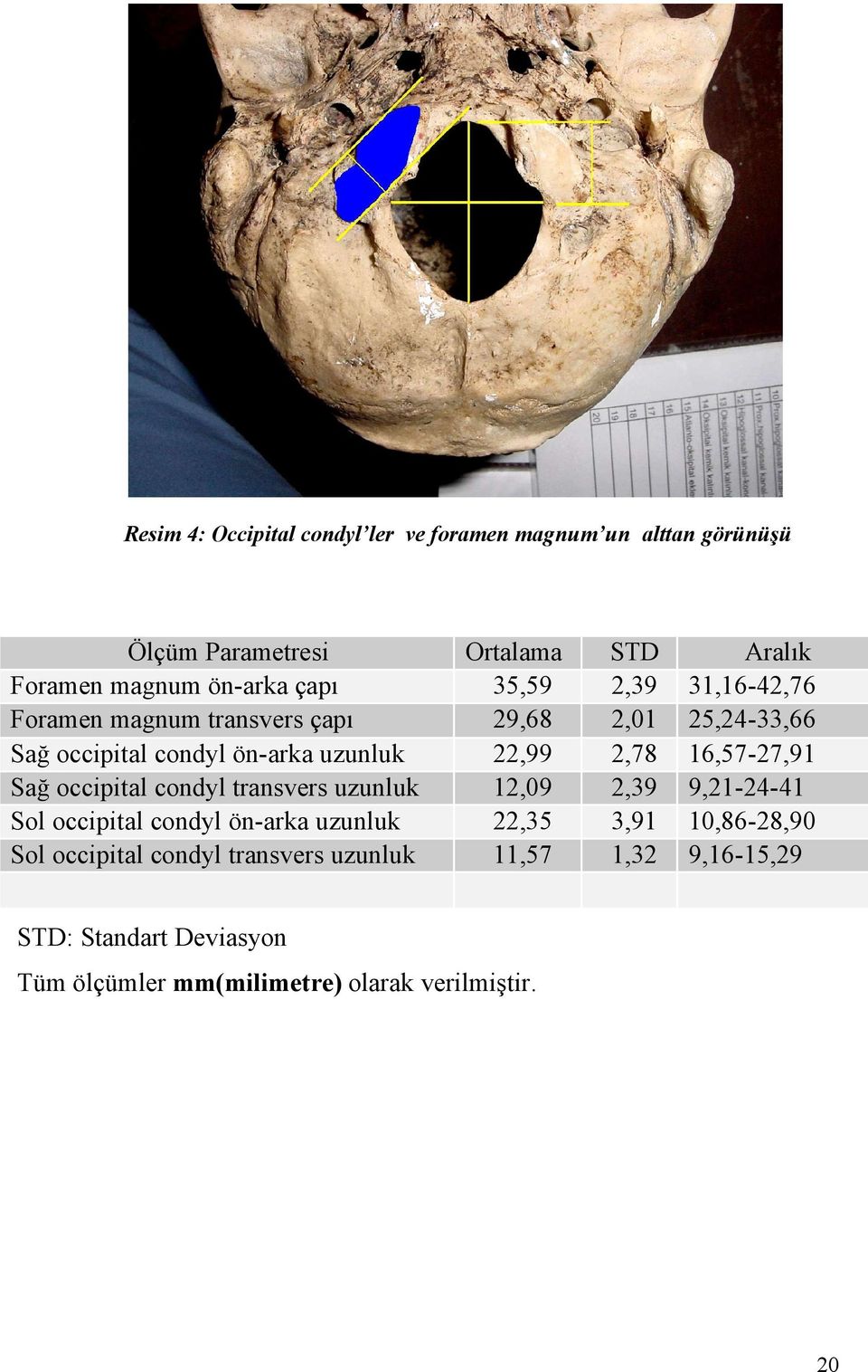 Sol occipital condyl transvers uzunluk Ortalama 35,59 29,68 22,99 12,09 22,35 11,57 STD 2,39 2,01 2,78 2,39 3,91 1,32 Aralık