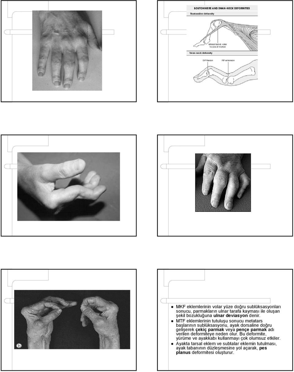 MTF eklemlerinin tutuluşu sonucu metatars başlarının sublüksasyonu, ayak dorsaline doğru gelişerek çekiç parmak veya pençe