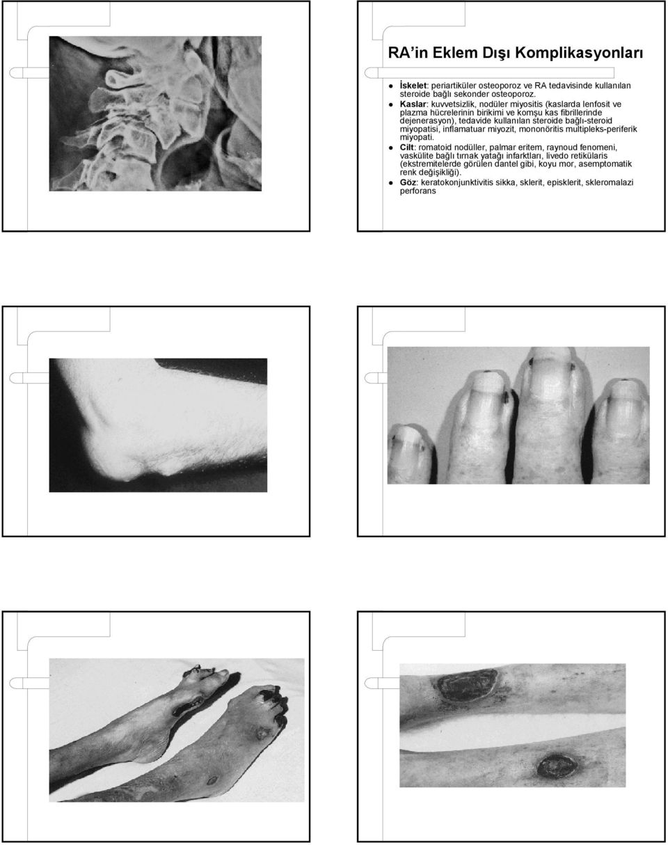 bağlı-steroid miyopatisi, inflamatuar miyozit, mononöritis multipleks-periferik miyopati.