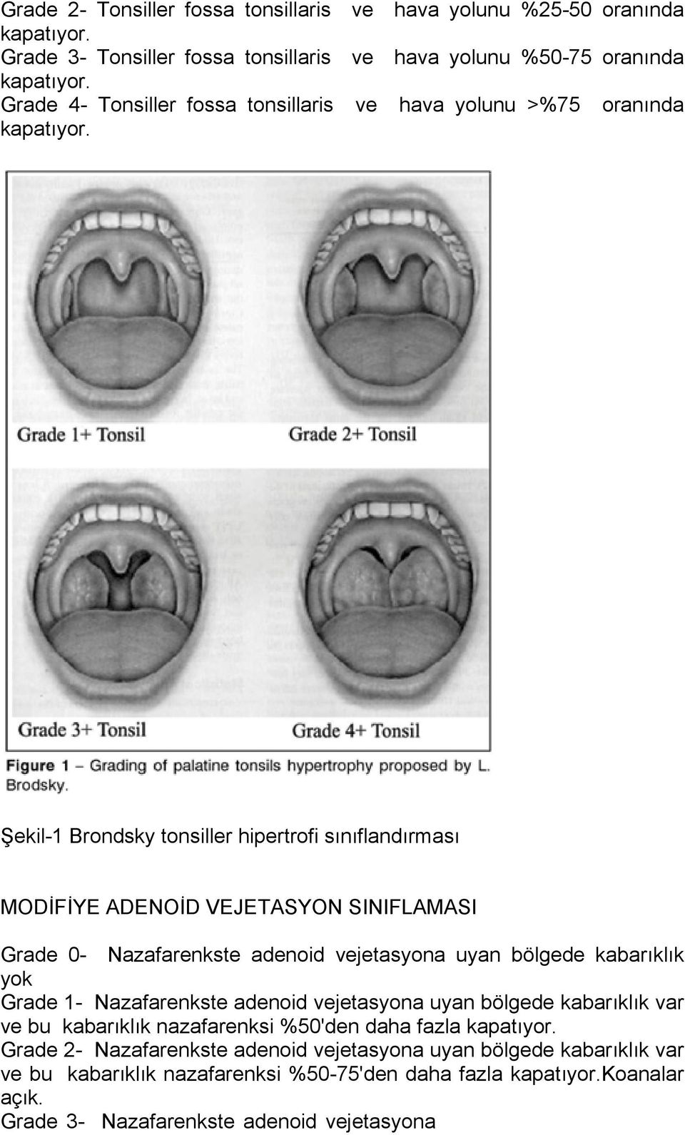 Şekil-1 Brondsky tonsiller hipertrofi sınıflandırması MODİFİYE ADENOİD VEJETASYON SINIFLAMASI Grade 0- Nazafarenkste adenoid vejetasyona uyan bölgede kabarıklık yok Grade 1-