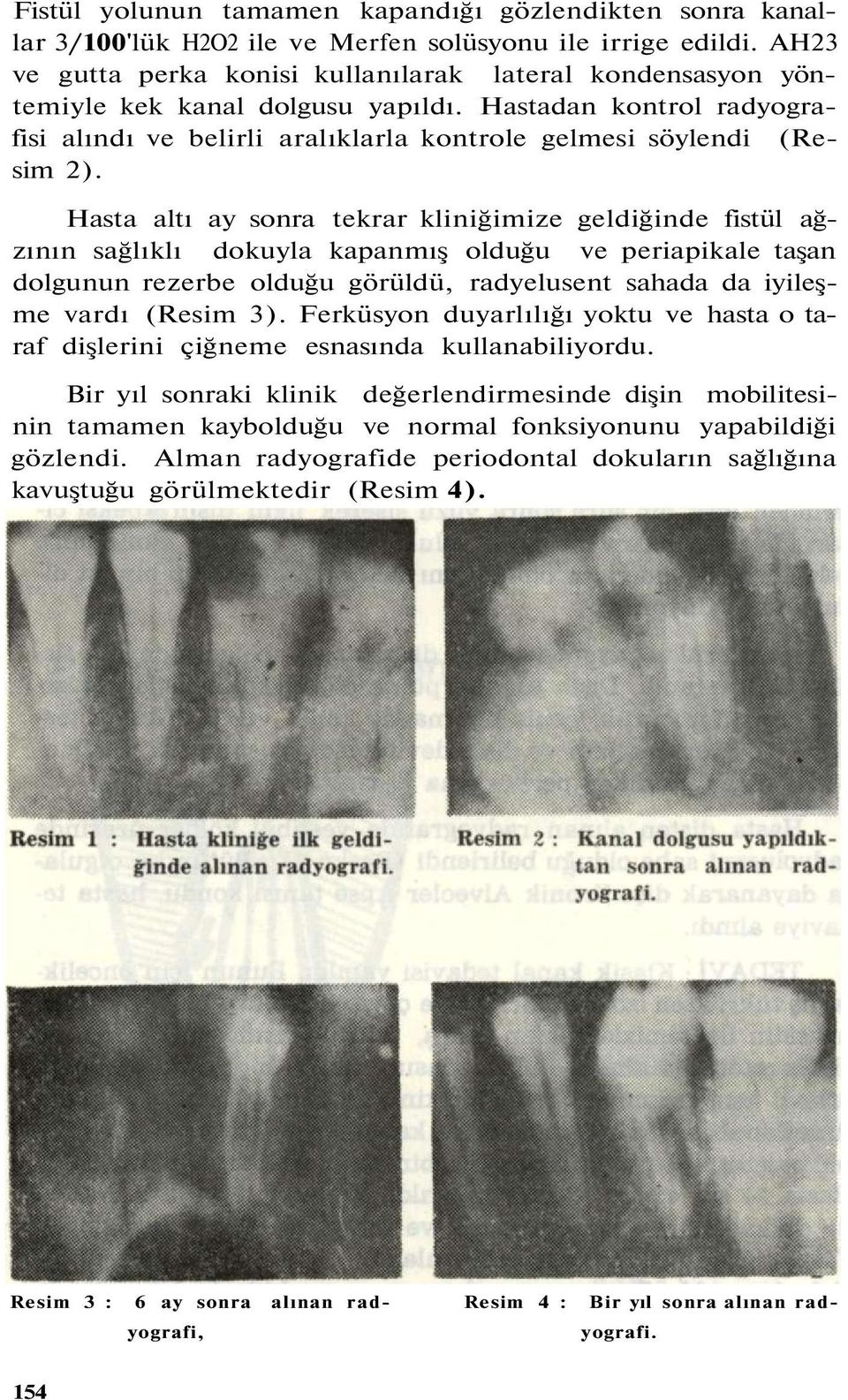 Hasta altı ay sonra tekrar kliniğimize geldiğinde fistül ağzının sağlıklı dokuyla kapanmış olduğu ve periapikale taşan dolgunun rezerbe olduğu görüldü, radyelusent sahada da iyileşme vardı (Resim 3).