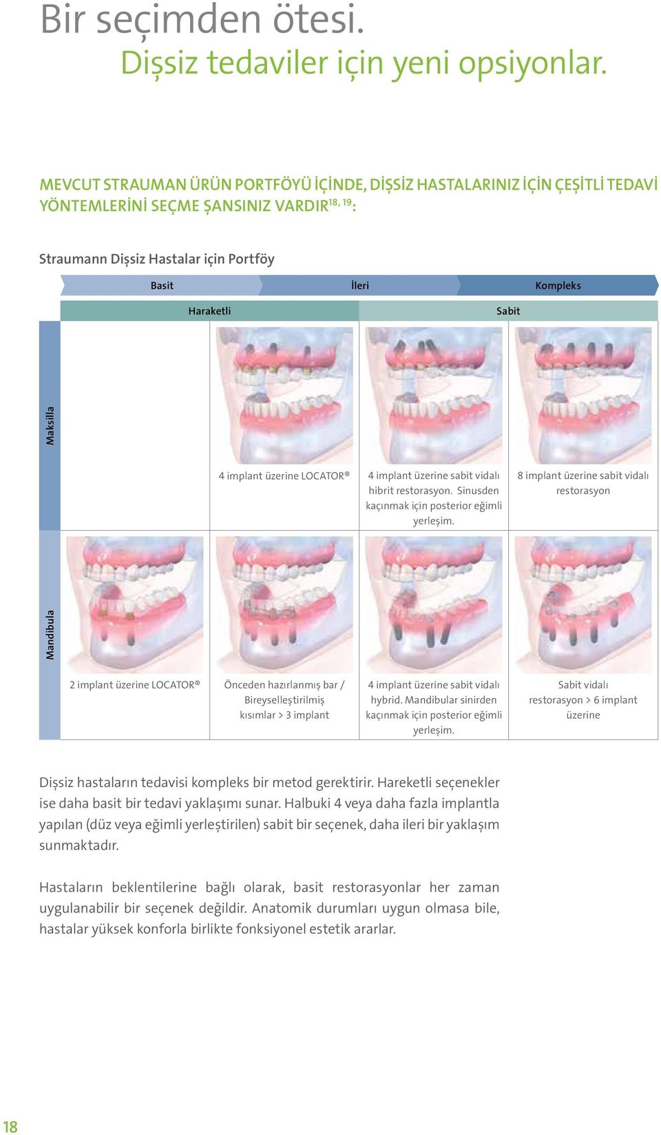 Maksilla 4 implant üzerine LOCATOR 4 implant üzerine sabit vidalı hibrit restorasyon. Sinusden kaçınmak için posterior eğimli yerleşim.