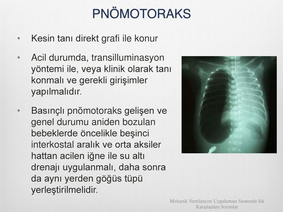 Basınçlı pnömotoraks gelişen ve genel durumu aniden bozulan bebeklerde öncelikle beşinci interkostal aralık ve