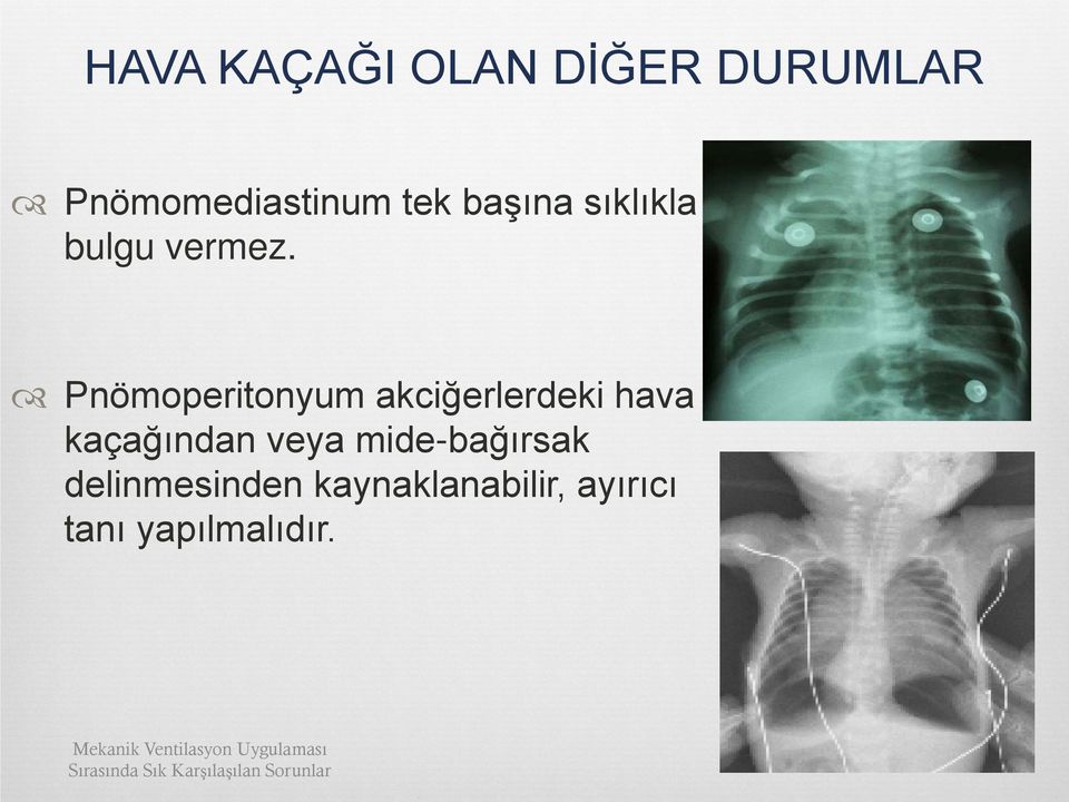 Pnömoperitonyum akciğerlerdeki hava kaçağından veya mide-bağırsak