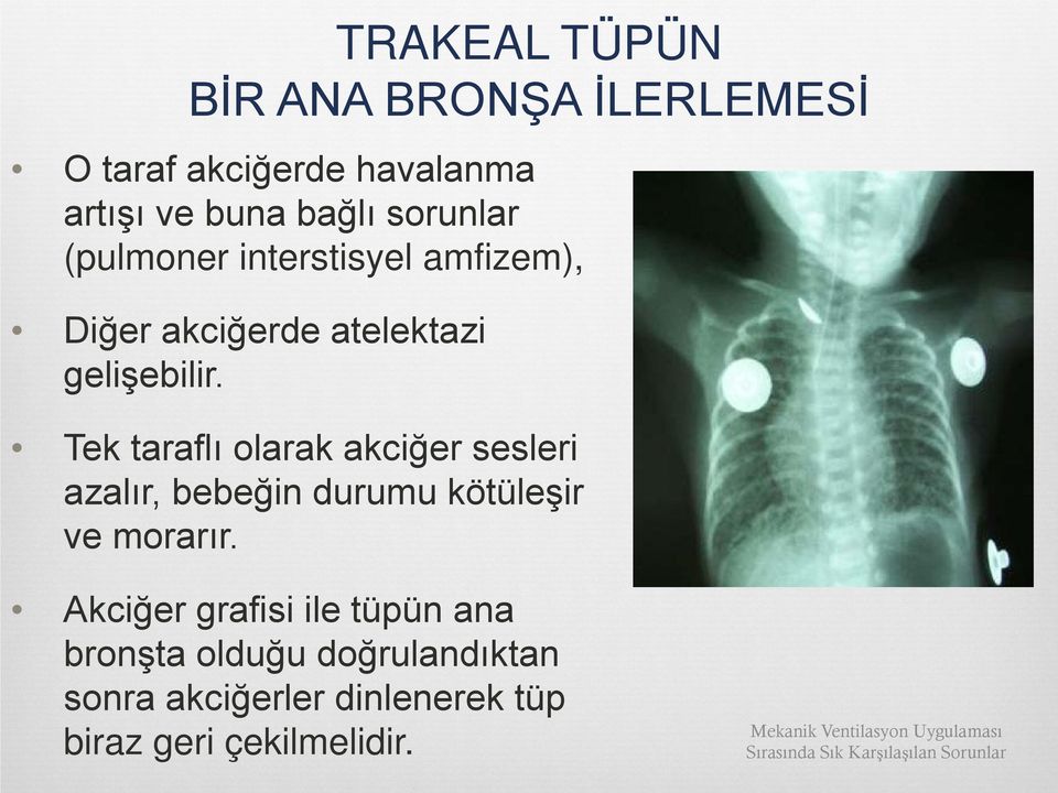 Tek taraflı olarak akciğer sesleri azalır, bebeğin durumu kötüleşir ve morarır.