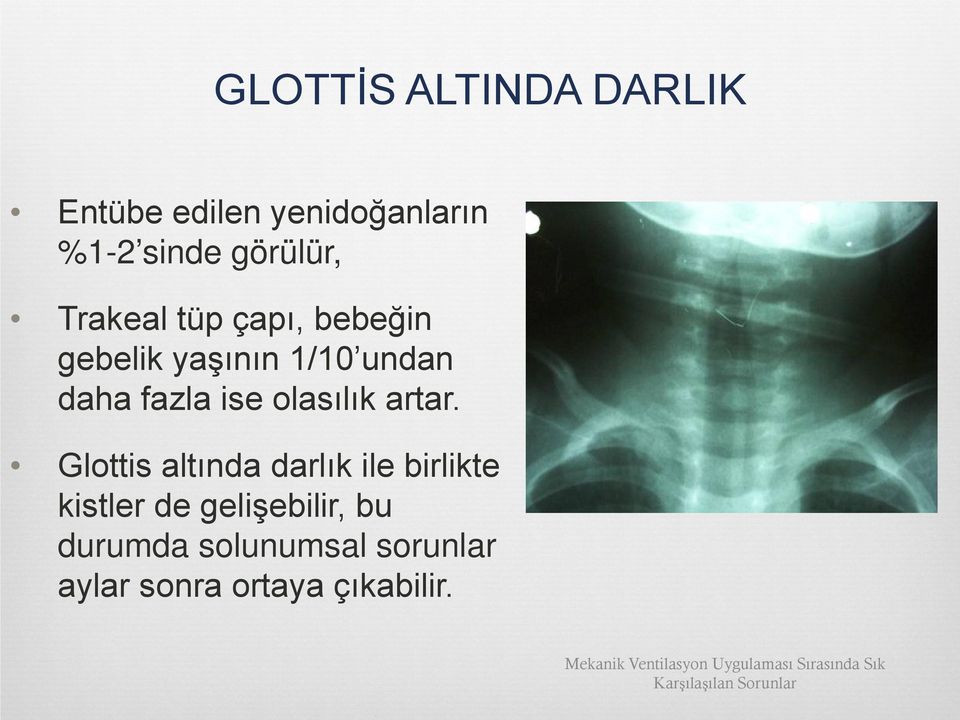 Glottis altında darlık ile birlikte kistler de gelişebilir, bu durumda solunumsal