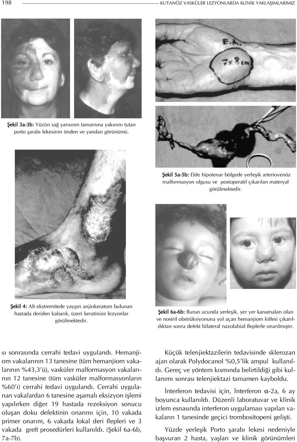 Şekil 4: Alt ekstremitede yaygın anjiokeratom bulunan hastada deriden kabarık, üzeri keratinize lezyonlar görülmektedir.
