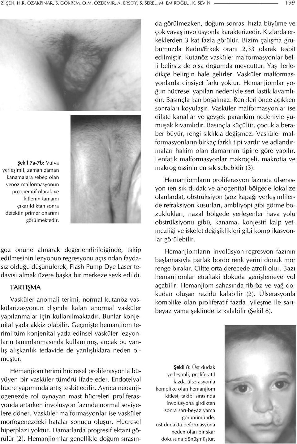 göz önüne alınarak değerlendirildiğinde, takip edilmesinin lezyonun regresyonu açısından faydasız olduğu düşünülerek, Flash Pump Dye Laser tedavisi almak üzere başka bir merkeze sevk edildi.