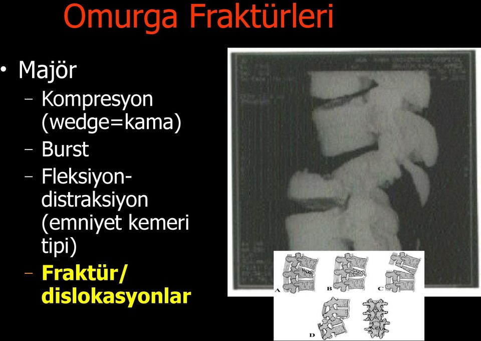 Fleksiyodistraksiyo (emiyet