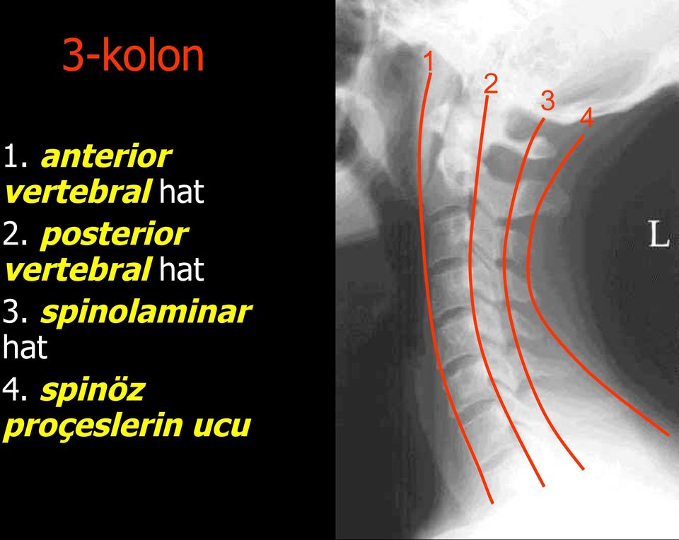 posterior vertebral hat 3.