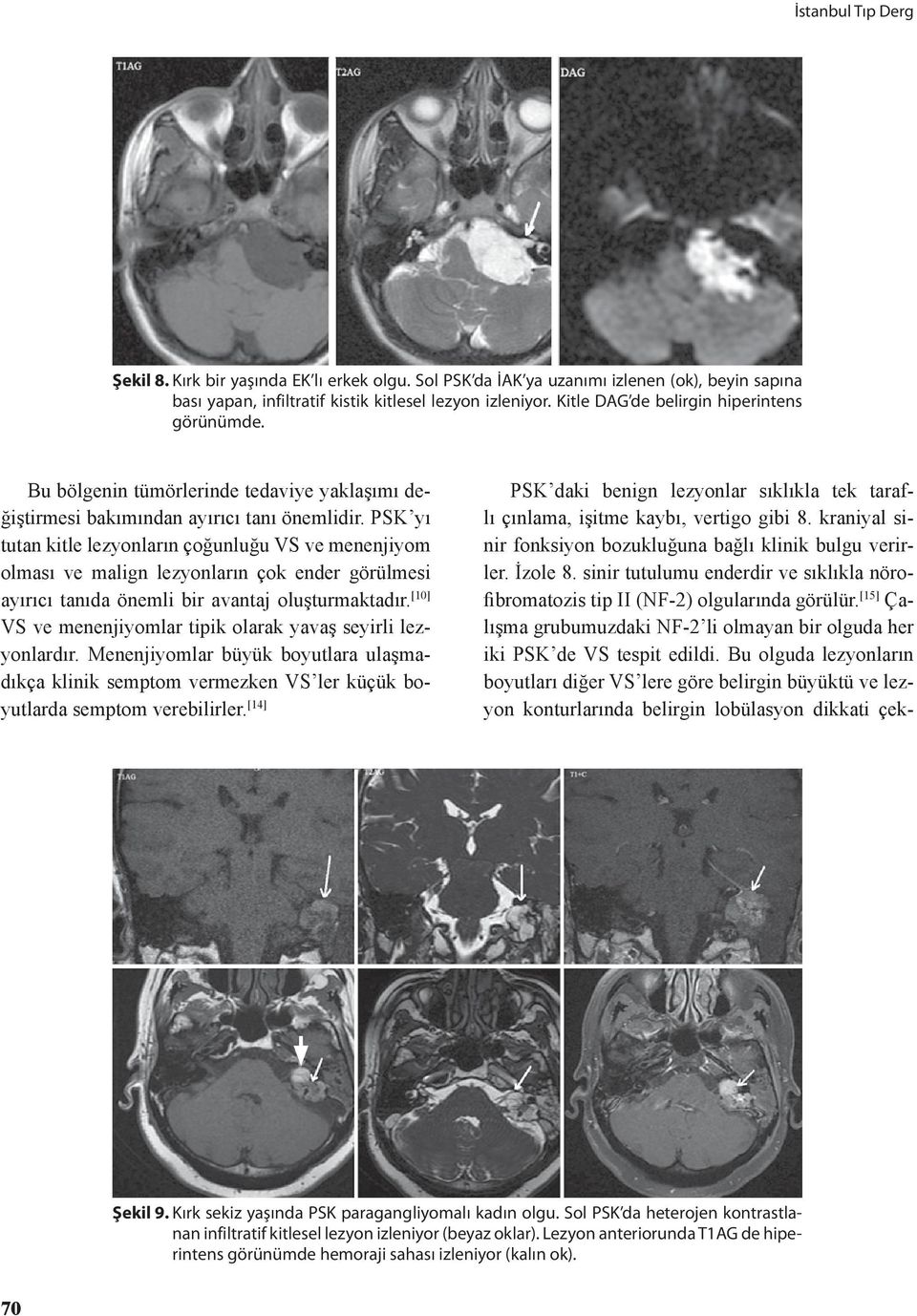 PSK yı tutan kitle lezyonların çoğunluğu VS ve menenjiyom olması ve malign lezyonların çok ender görülmesi ayırıcı tanıda önemli bir avantaj oluşturmaktadır.