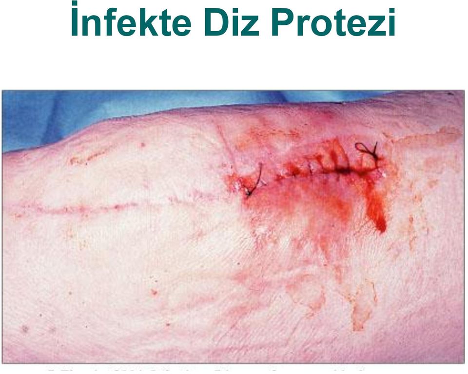 Protezi