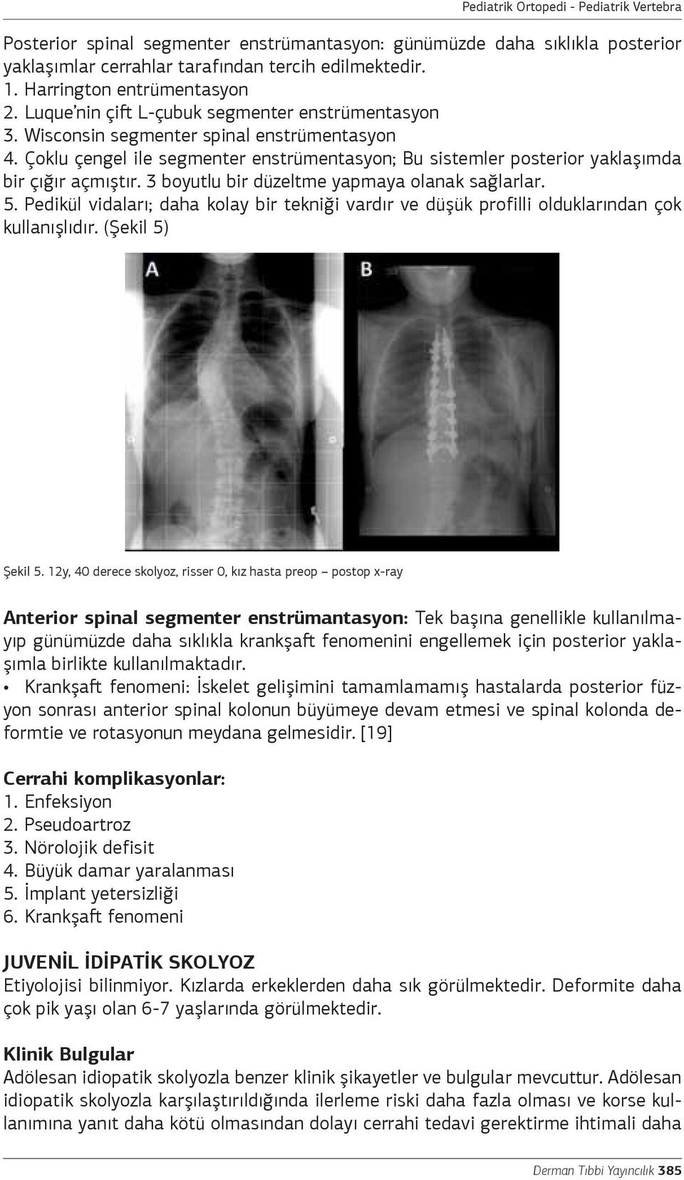 3 boyutlu bir düzeltme yapmaya olanak sağlarlar. 5. Pedikül vidaları; daha kolay bir tekniği vardır ve düşük profilli olduklarından çok kullanışlıdır. (Şekil 5) Şekil 5.