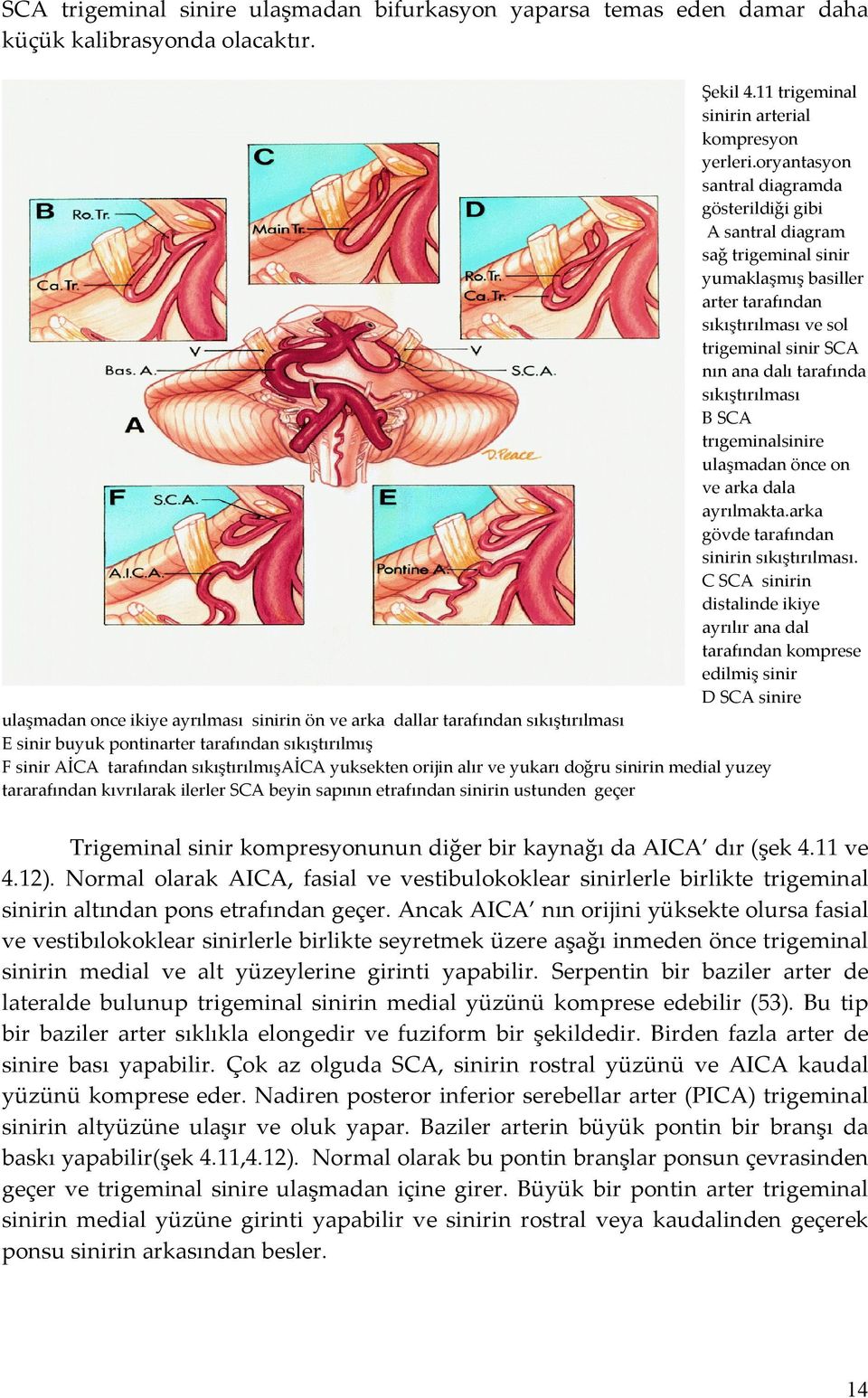 sıkıştırılması B SCA trıgeminalsinire ulaşmadan önce on ve arka dala ayrılmakta.arka gövde tarafından sinirin sıkıştırılması.