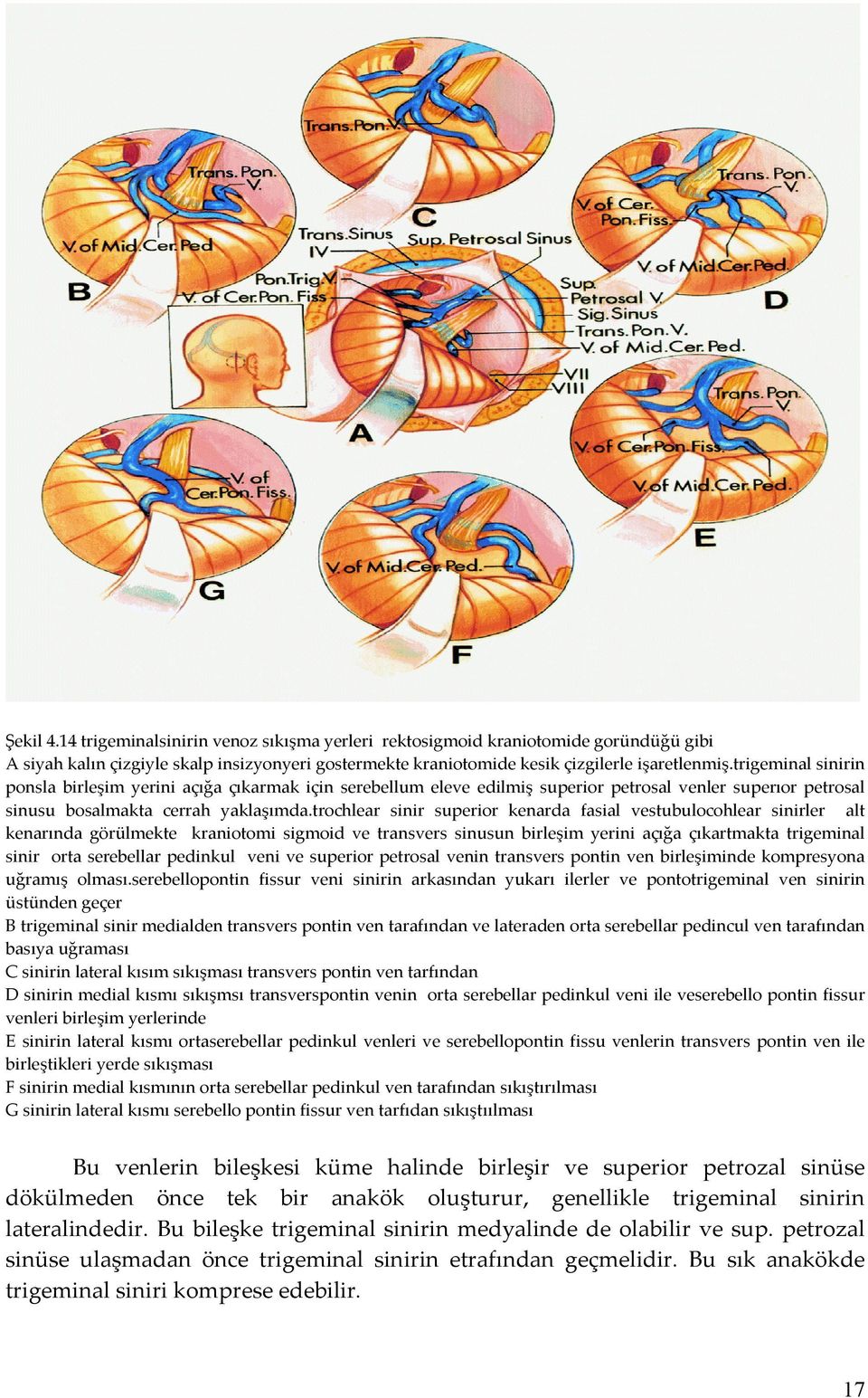 trochlear sinir superior kenarda fasial vestubulocohlear sinirler alt kenarında görülmekte kraniotomi sigmoid ve transvers sinusun birleşim yerini açığa çıkartmakta trigeminal sinir orta serebellar