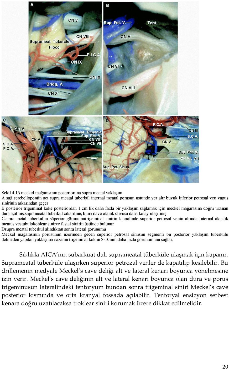 arkasından geçer B posterior trigeminal koke posteriordan 1 cm lik daha fazla bir yaklaşım sağlamak için meckel mağarasına doğru uzanan dura açılmış.