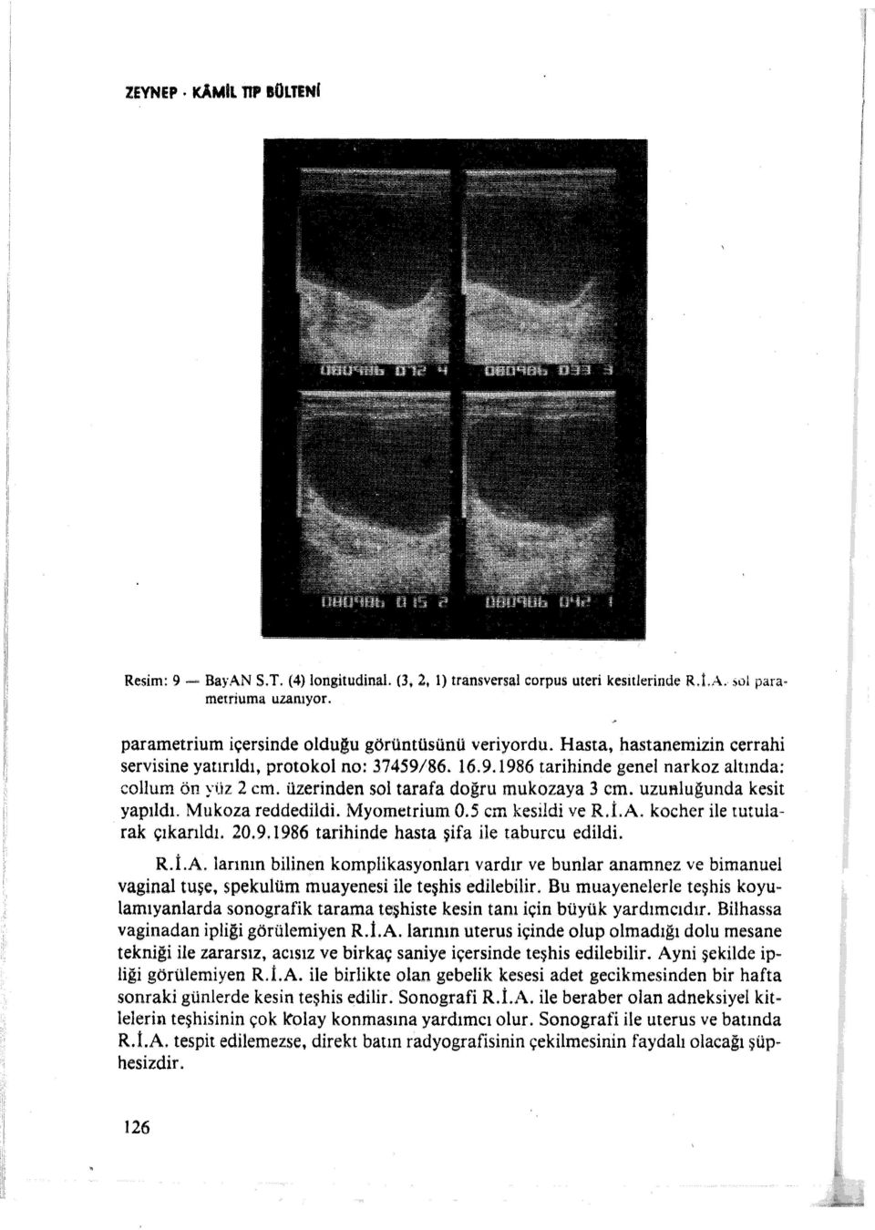 uzuftluğunda kesit yapıldı. Mukoza reddedildi. Myometrium 0.5 cm kesildi ve R..A. kocher ile tutularak çıkarıldı. 20.9.986 tarihinde hasta şifa ile taburcu edildi. R.İ.A. larının bilinen komplikasyonları vardır ve bunlar anamnez ve bimanuel vagina!