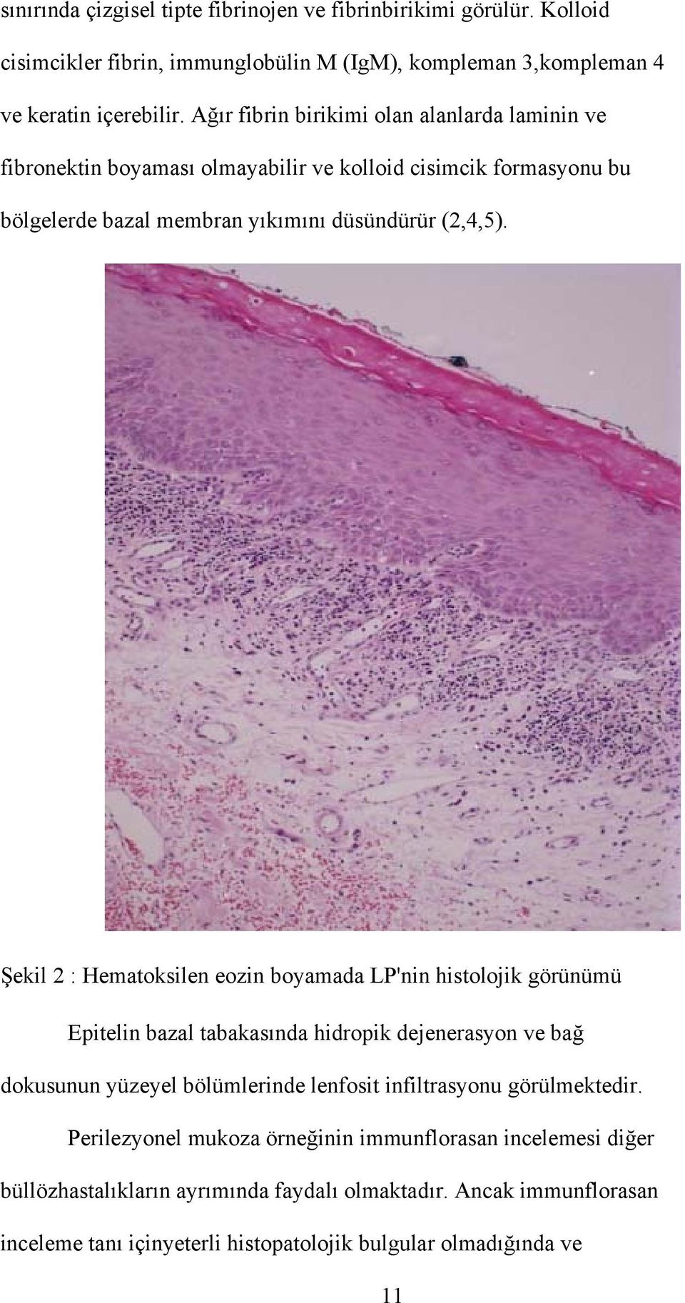 Şekil 2 : Hematoksilen eozin boyamada LP'nin histolojik görünümü Epitelin bazal tabakasında hidropik dejenerasyon ve bağ dokusunun yüzeyel bölümlerinde lenfosit infiltrasyonu