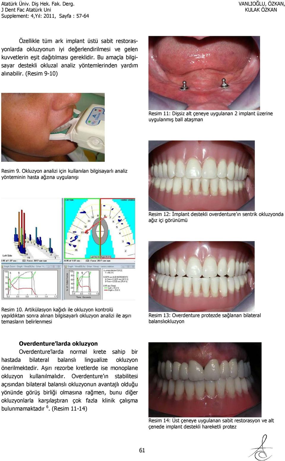 Okluzyon analizi için kullanılan bilgisayarlı analiz yönteminin hasta ağzına uygulanışı Resim 12: İmplant destekli overdenture ın sentrik okluzyonda ağız içi görünümü Resim 10.