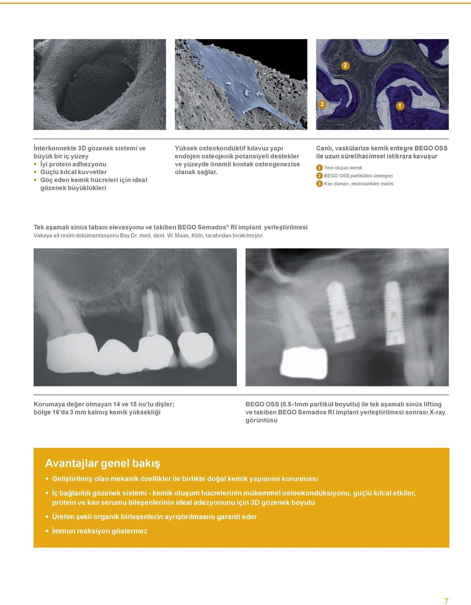 Canlı, vaskülarize kemik entegre BEGO OSS ile uzun sürelihacimsel istikrara kavuşur 1 Yeni oluşan kemik 2 BEGO OSS partikülleri (entegre) Kan damarı, ekstrasellüler matris Tek aşamalı sinüs tabanı