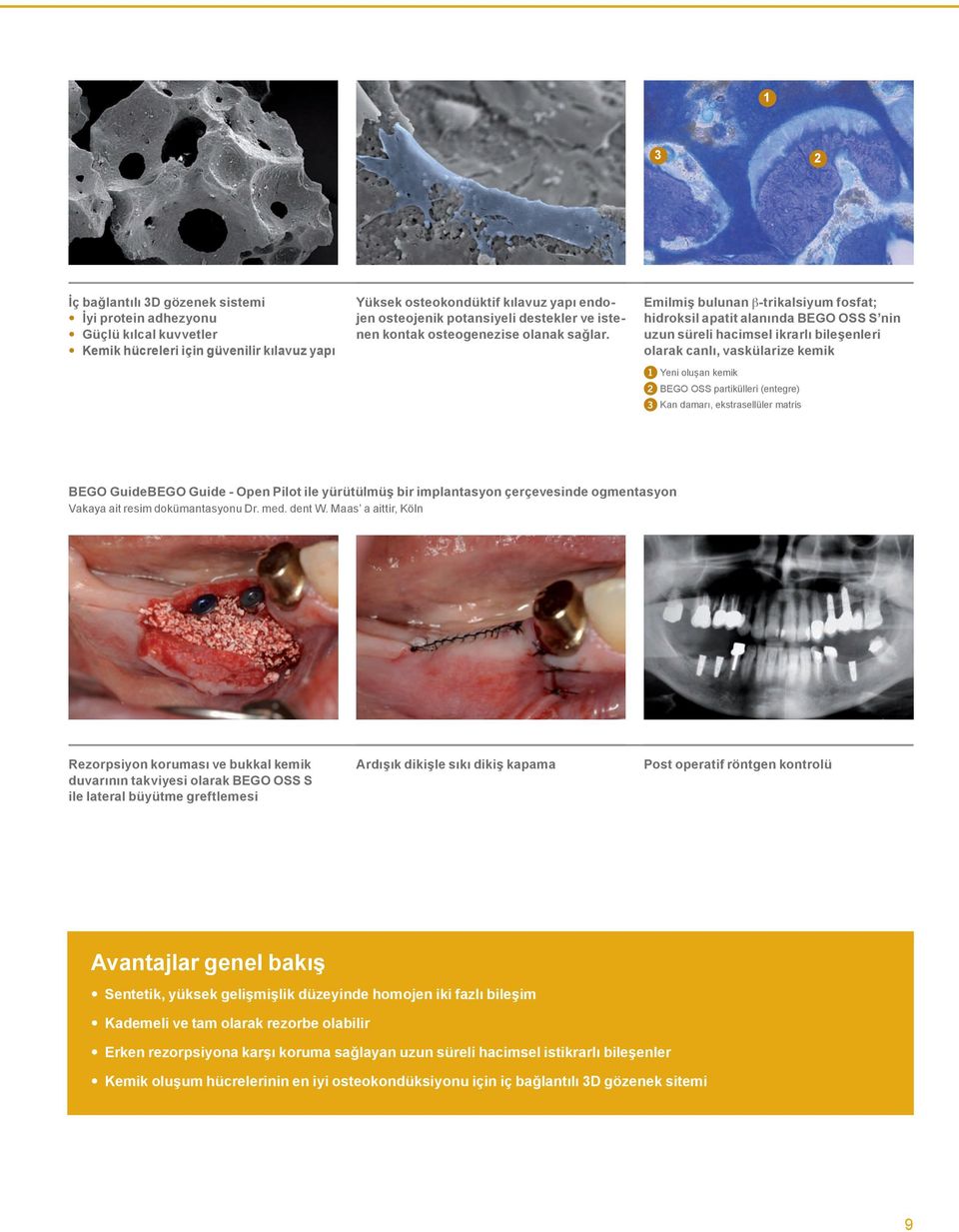 Emilmiş bulunan β-trikalsiyum fosfat; hidroksil apatit alanında BEGO OSS S nin uzun süreli hacimsel ikrarlı bileşenleri olarak canlı, vaskülarize kemik 1 Yeni oluşan kemik 2 BEGO OSS partikülleri