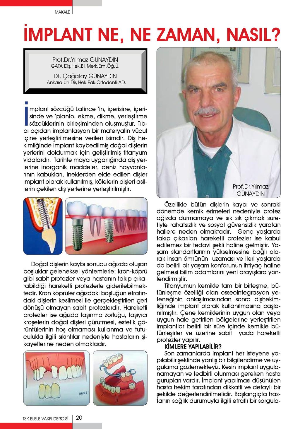 Tıbbı açıdan implantasyon bir materyalin vücut içine yerleştirilmesine verilen isimdir. Diş hekimliğinde implant kaybedilmiş doğal dişlerin yerlerini doldurmak için geliştirilmiş titanyum vidalardır.