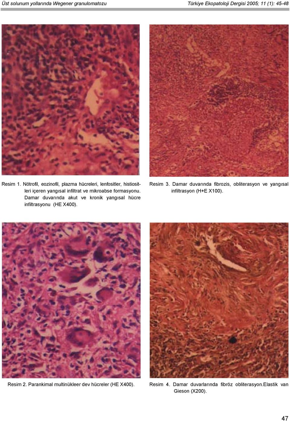 Damar duvarında akut ve kronik yangısal hücre infiltrasyonu (HE X400). Resim 3.