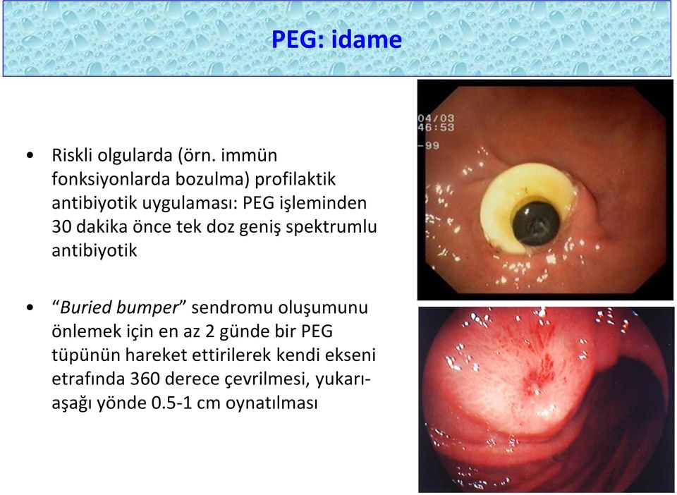 dakika önce tek doz geniş spektrumlu antibiyotik Buried bumper sendromu oluşumunu