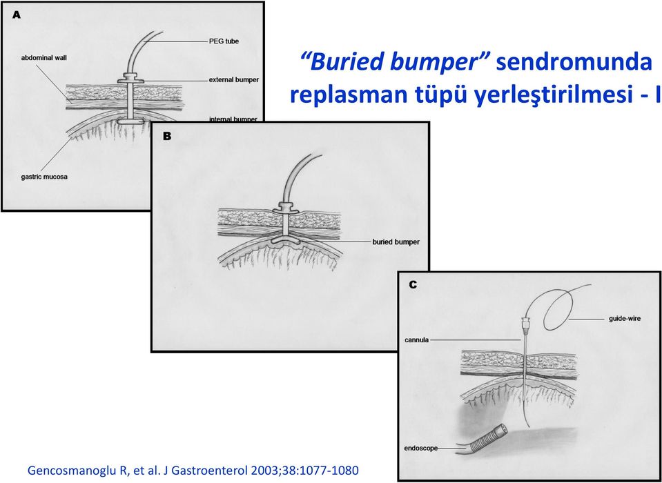 2003;38:1077-1080 Buried