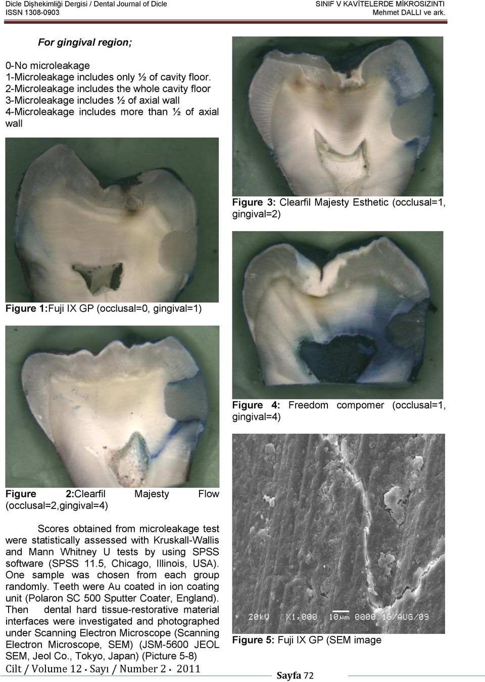 Figure 1:Fuji IX GP (occlusal=0, gingival=1) Figure 4: Freedom compomer (occlusal=1, gingival=4) Figure 2:Clearfil Majesty Flow (occlusal=2,gingival=4) Scores obtained from microleakage test were